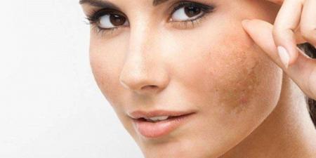 مع ارتفاع درجات الحرارة.. كيف تحمي نفسك من البقع الشمسية؟ - تكنو بلس