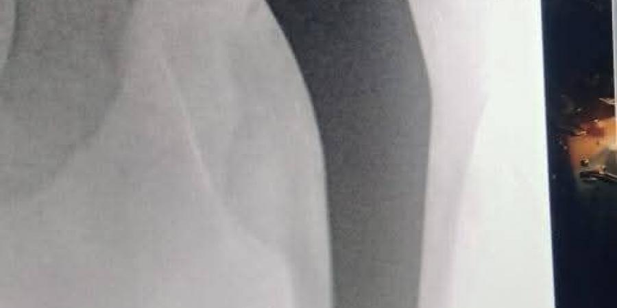 أطباء مستشفى ههيا المركزي ينجحون في إجراء جراحة دقيقة لتركيب مفصل الفخذ لإنفاذ مريض من الإعاقة - تكنو بلس