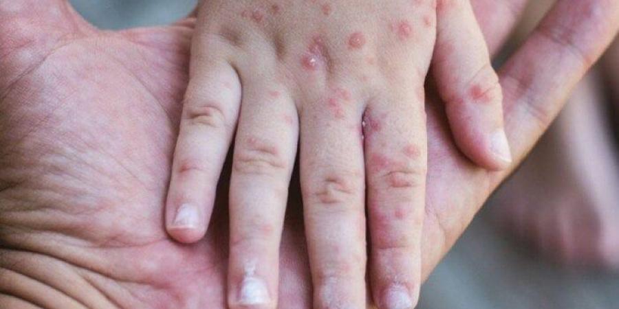 حالات الحصبة في كندا تصل إلى أعلى مستوى لها منذ 30 عاما - تكنو بلس