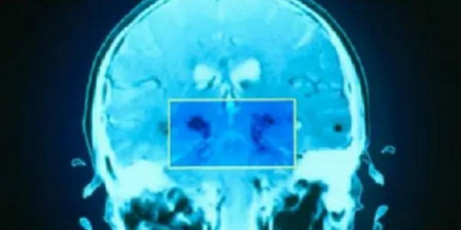 6 حيل تعالج الضغط العصبي والقلق ومشاكل المخ - تكنو بلس